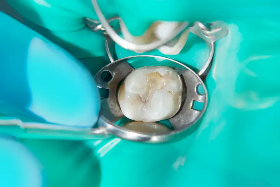 The Role of Dental Restoration in Tooth Preservation Richmond, VA The Role of Dental Restoration in Tooth Preservation Richmond, VA