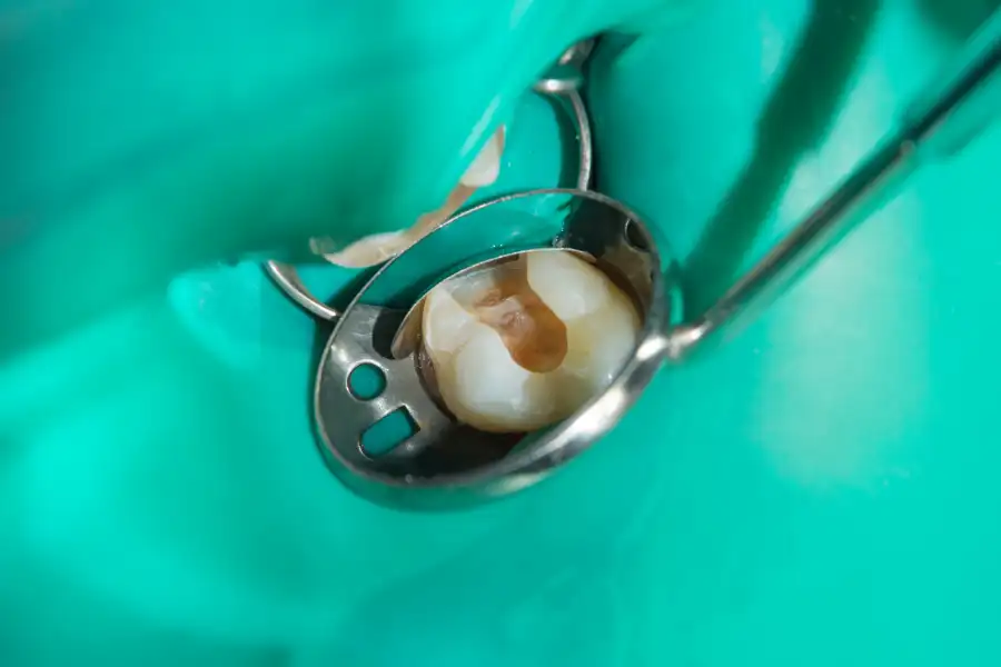 The Role of Dental Restoration in Tooth Preservation in Richmond, VA The Role of Dental Restoration in Tooth Preservation in Richmond, VA