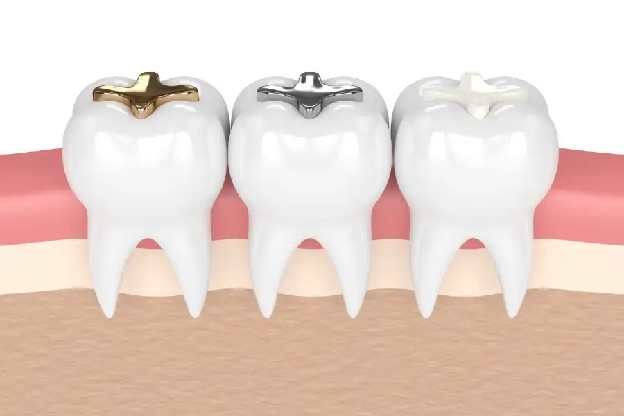 Types of Dental Filling Materials Explained Richmond, VA Types of Dental Filling Materials Explained Richmond, VA