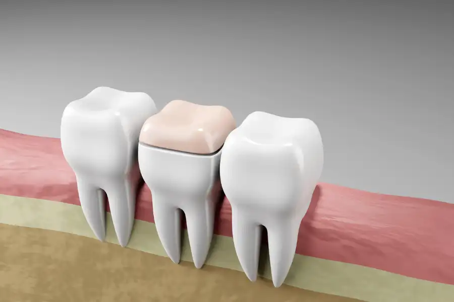 Types of Dental Filling Materials Explained in Richmond, VA Types of Dental Filling Materials Explained in Richmond, VA